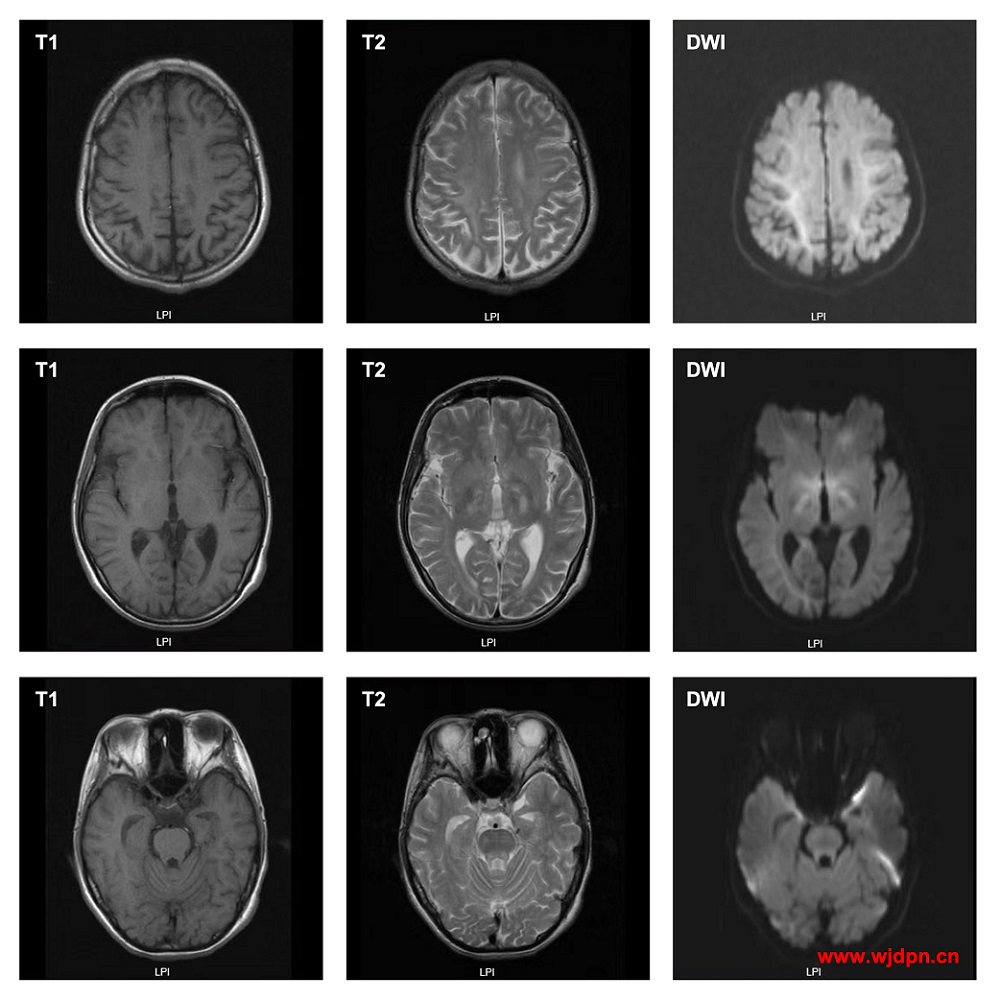 Kearns Sayre syndrome MRI