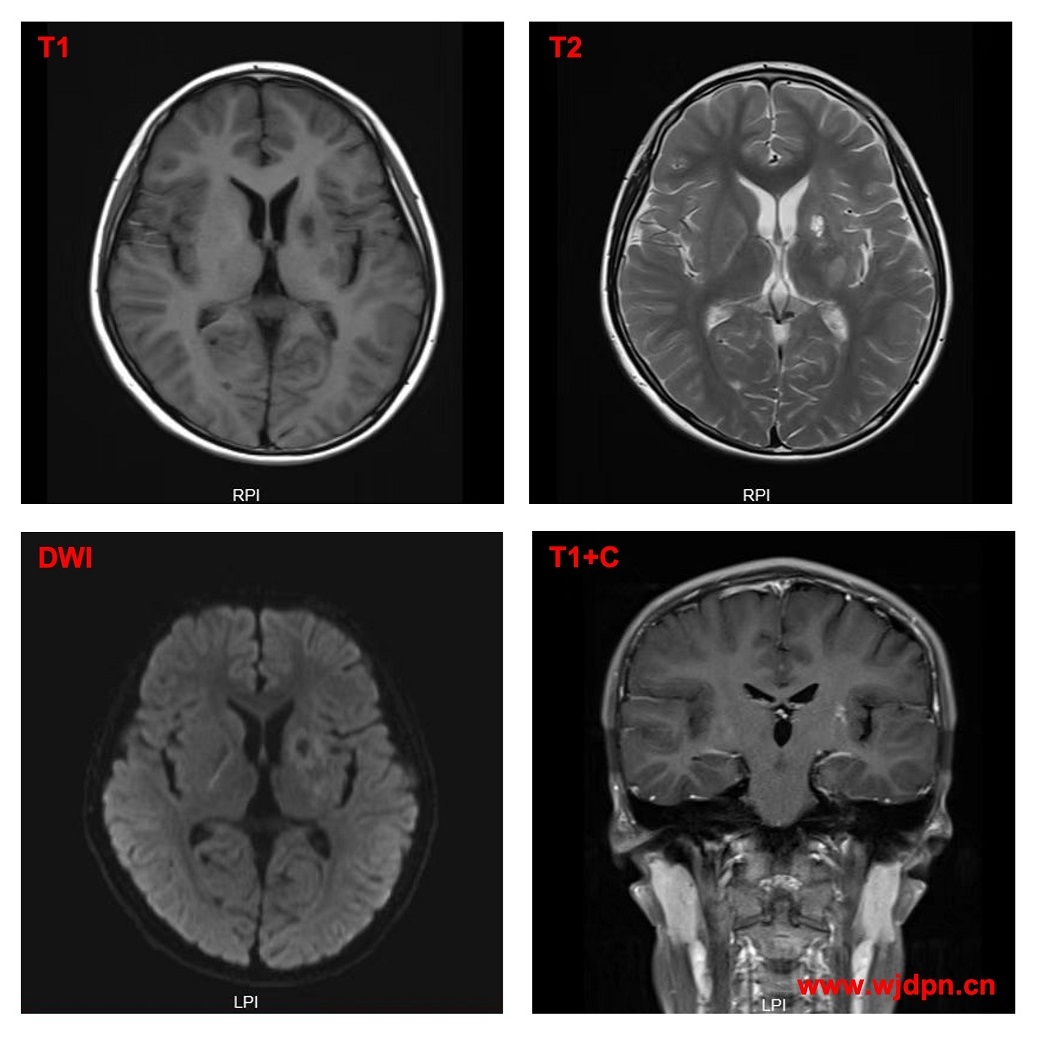 basal ganglia germ cell tumor