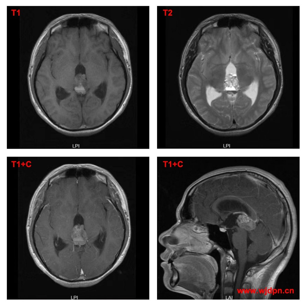 pineal region germ cell tumor
