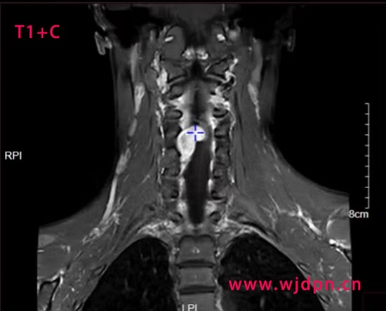 neurilemmoma T1C cor