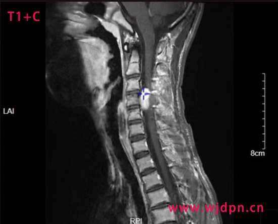 neurilemmoma T1C sag