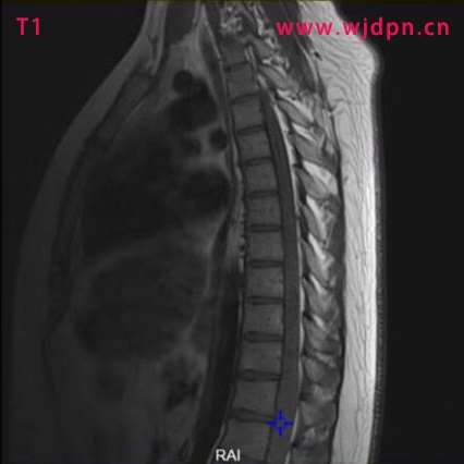 T1 glioma