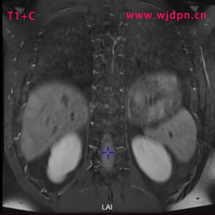 T1+C cor glioma