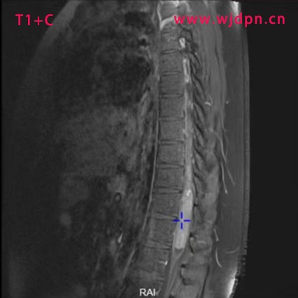 T1+C sag glioma