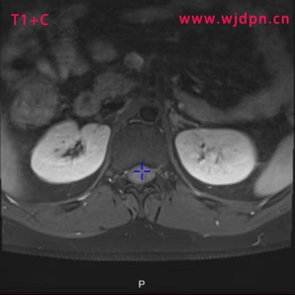 T1+C tra glioma