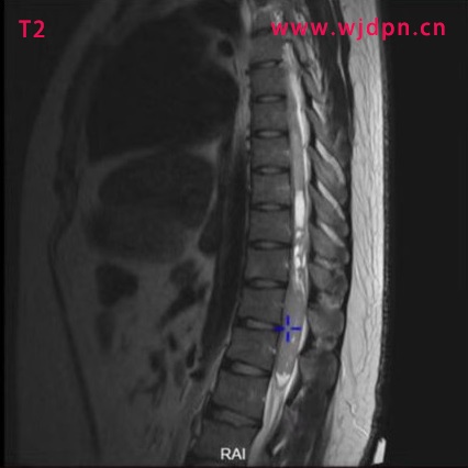 T2 glioma